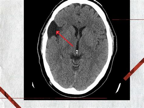 Arachnoid Cysts: What Are They, Location, Causes & Symptoms.